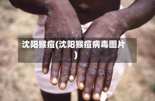 沈阳猴痘(沈阳猴痘病毒图片)-第3张图片